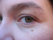 ホクロの数は若さの証拠？